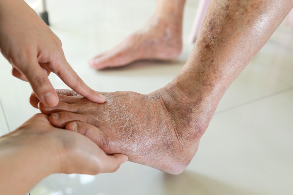 Hands,Of,Doctor,Or,Nurse,Examining,The,Dry,cracked,swollen,Feet,Of